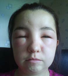 英国少女染发过敏 头部肿大(图)-染发剂,头部,过