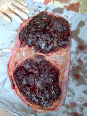 倒卖人体胎盘 触目惊心的黑幕(组图)-胎盘,危险