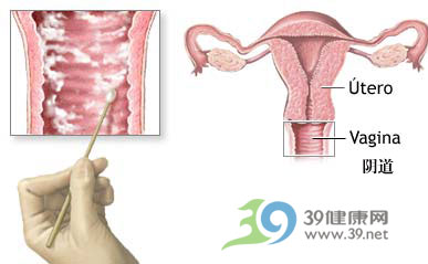 冬季女性应防三大妇科病(组图)-炎症,盆腔炎,妇