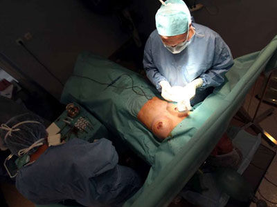 硅胶隆胸对人体的危害有多大-隆胸手术,硅胶假