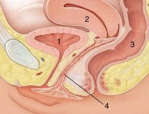 真人演示女用避孕套使用方法-女用避孕套,演