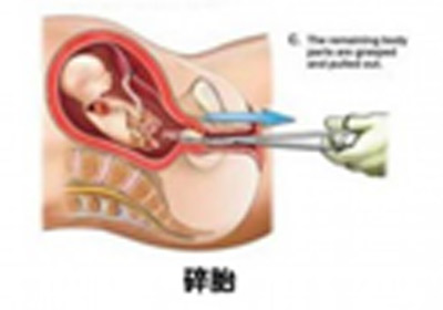 试管手术疼吗+试管怀孕疼吗