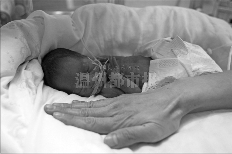 乐清一医院诞下手掌女 婴早产两个月体重不足