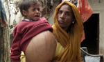 印度幼女腹中长18斤巨型肿瘤