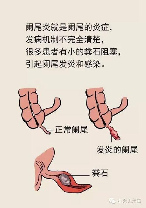 子痛以为吃坏东西 宁波打工男硬扛扛成阑尾脓