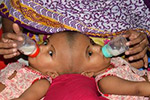 孟加拉国头部连体女婴将准备接受分离手术