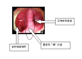 胸骨后剧痛难忍 竟是因为食管壁鼓包了
