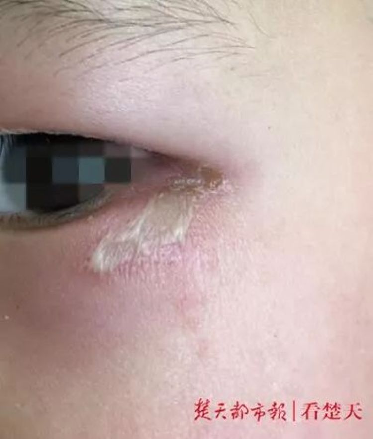 随手拍死一只虫皮肤竟烂了!这几种虫千万别用手拍
