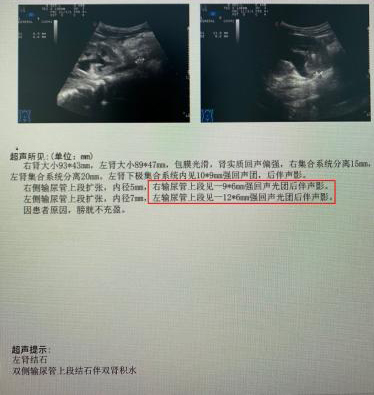 惊呆!宁波一名18个月大男婴肾脏,输尿管,膀胱长结石