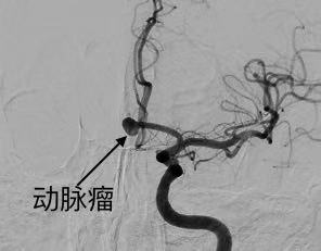 宁波七旬老伯错把头痛当感冒 一检查竟是脑动脉瘤破裂