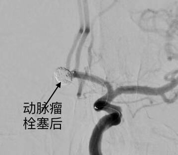 宁波七旬老伯错把头痛当感冒 一检查竟是脑动脉瘤破裂