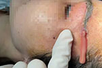 宁波女子太阳穴处流出10针管“粉色脂肪” 险些危及生命
