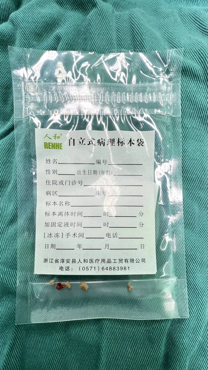 取出的部分结石.jpg 取出的部分结石.jpg